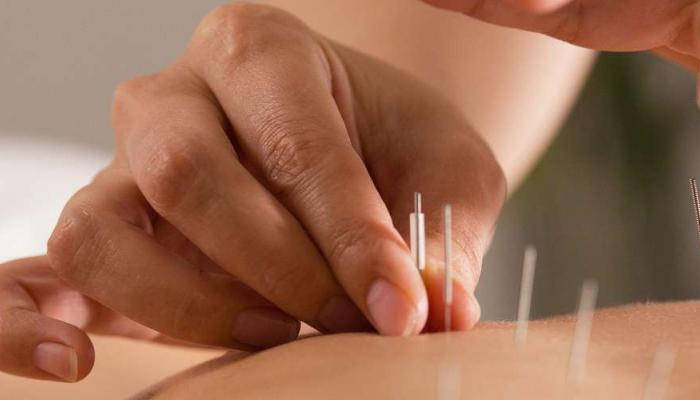 Akupunktur Therapeuten
